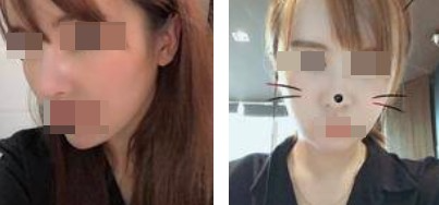 面部吸脂让你做一个更受欢迎的精致“小脸”的女人