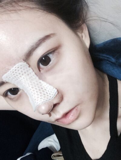 贵阳长江医院整形美容中心韩盛斌医生做自体脂肪隆鼻+全脸填充案例