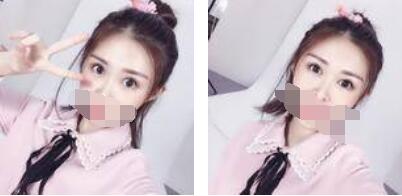 激光祛眼袋术后照片