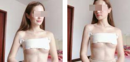 朴正淳假体隆胸案例分享