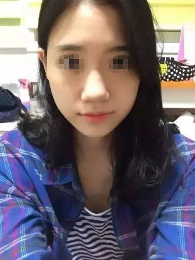 做完膨体隆鼻，鼻子变“挺”了