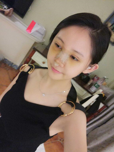 海南添美整形外科医生王晓军做自体软骨隆鼻+双眼皮+祛眼袋案例效果对比图