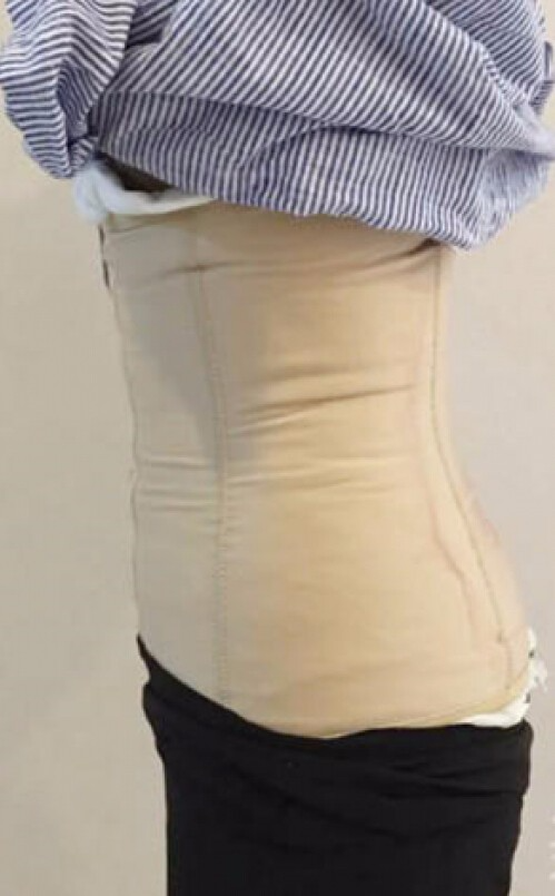 合肥壹加壹整形医生周福田做腰腹吸脂技术怎么样？附腰腹吸脂案例