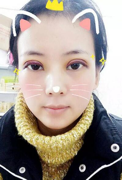 杨勇山双眼皮案例展示