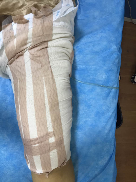广州军颐医院整形美容中心石建薇医生腰腹吸脂真实案例对比图