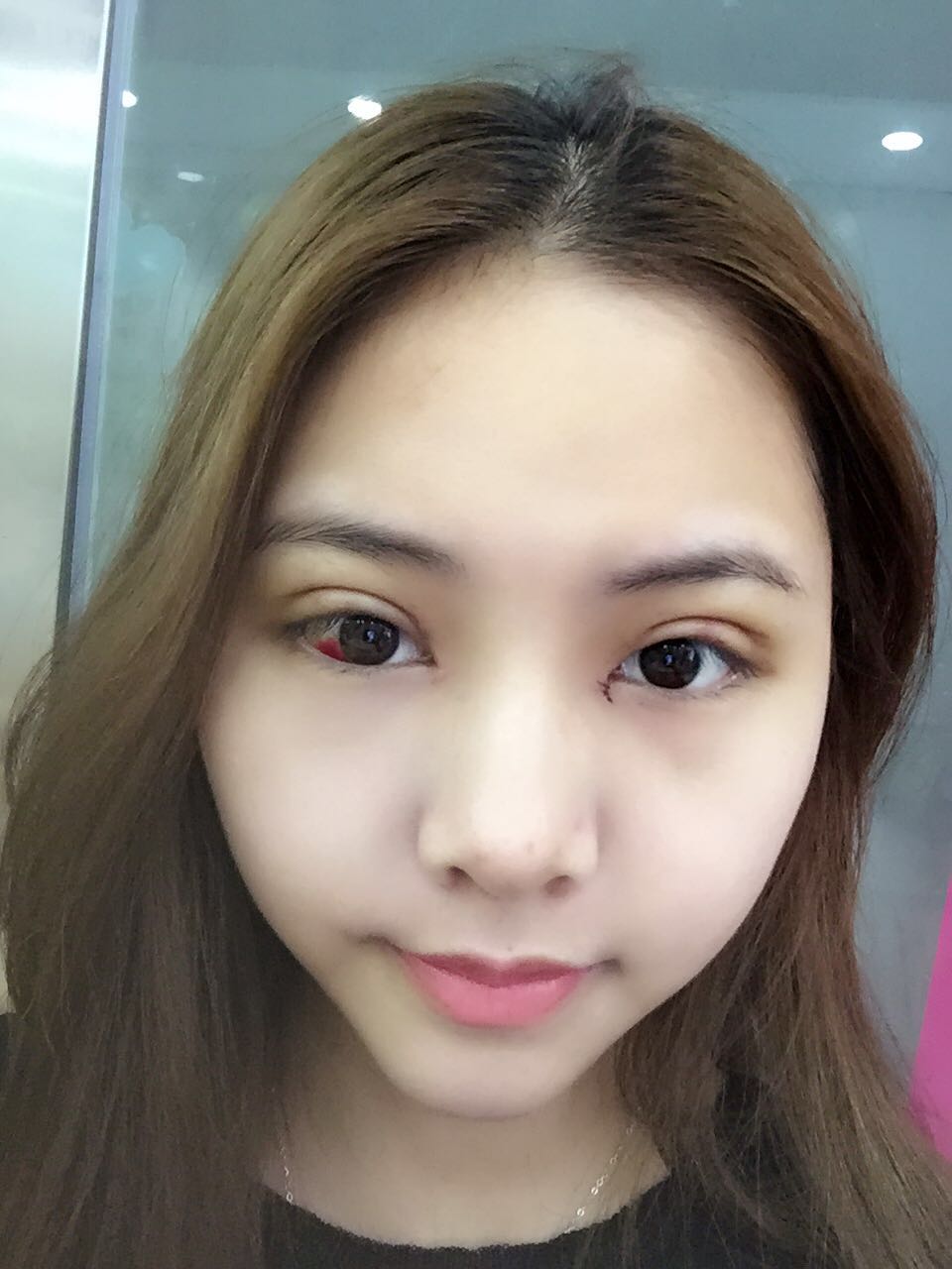整形医生徐长亮做切开双眼皮案例效果对比图