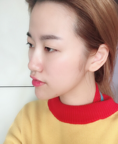 成都艺星陈远琨医生注射肉毒素瘦脸效果案例对比图