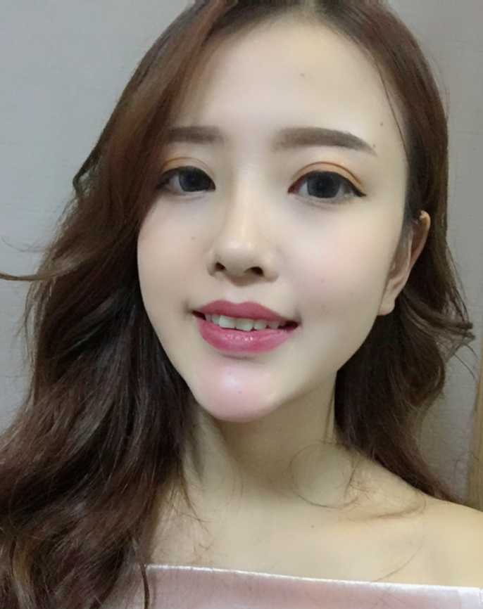 成都汉密尔顿牙齿矫正案例