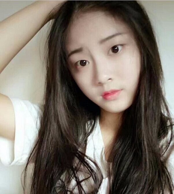 福州爱美尔整形黄林胜双眼皮案例效果对比图