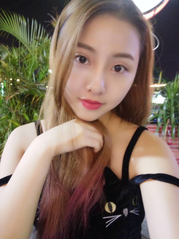 整形医生徐长亮做切开双眼皮案例效果对比图