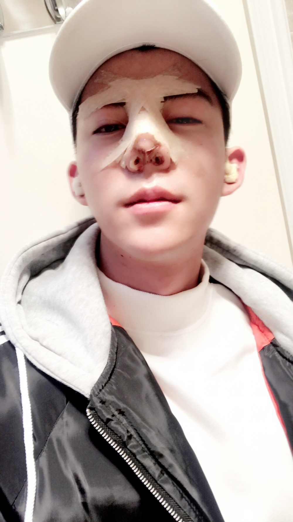济宁名美医疗整形医生李唯少假体隆鼻+耳软骨垫鼻尖真实案例效果对比图