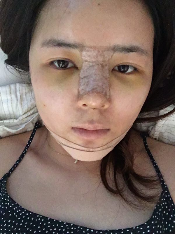 北京世济周志强医生鼻综合案例
