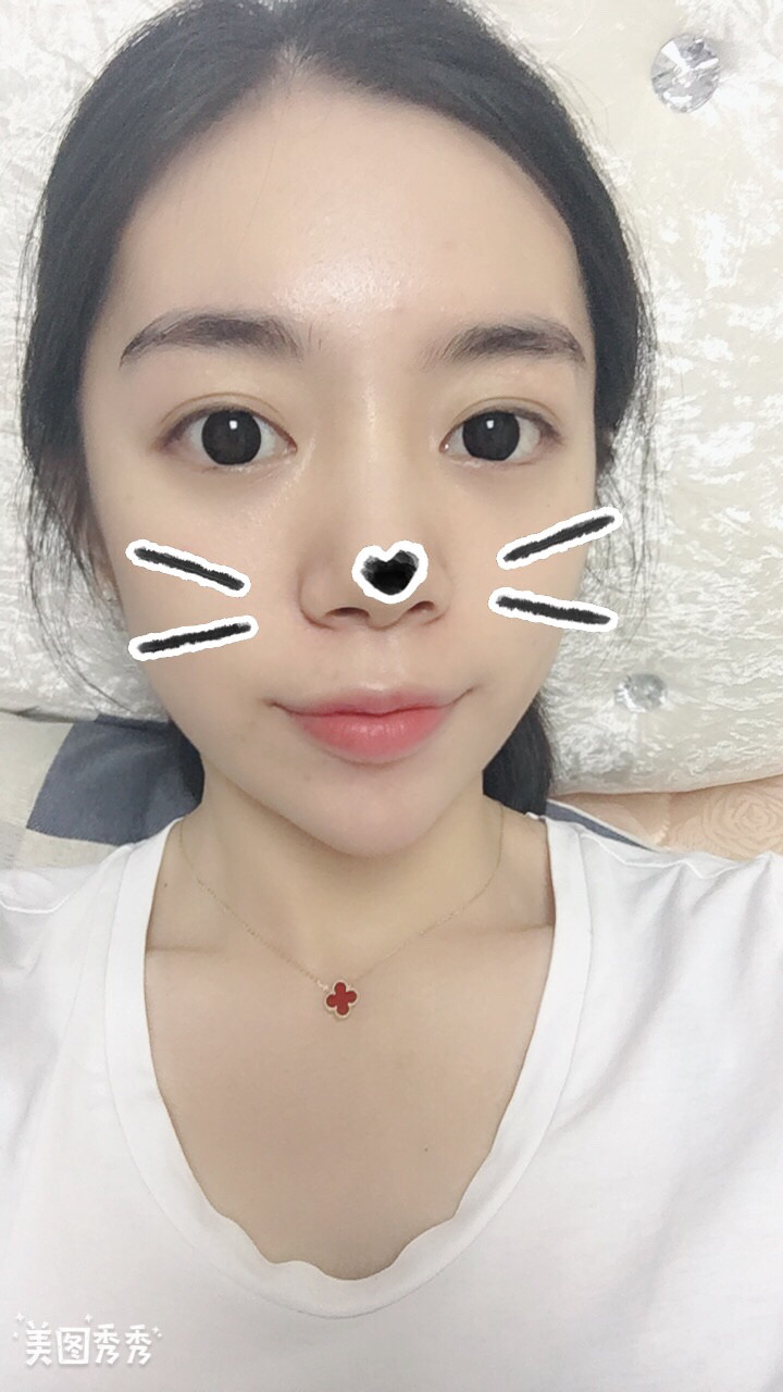 做完祛眼袋手术28天
