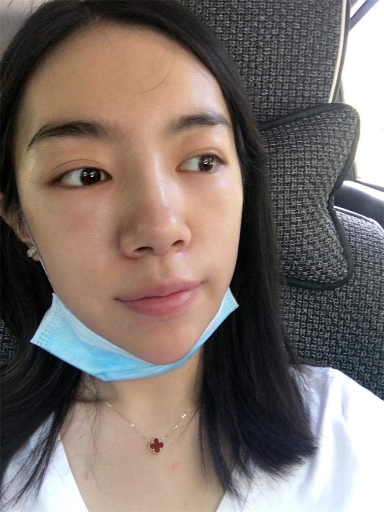 合肥壹加壹整形美容医院做祛眼袋效果怎么样？金大生祛眼袋案例分享