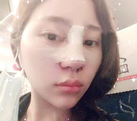 苏州明基医院医疗美容科做鼻综合整形怎么样？苏州明基鼻综合整形案例