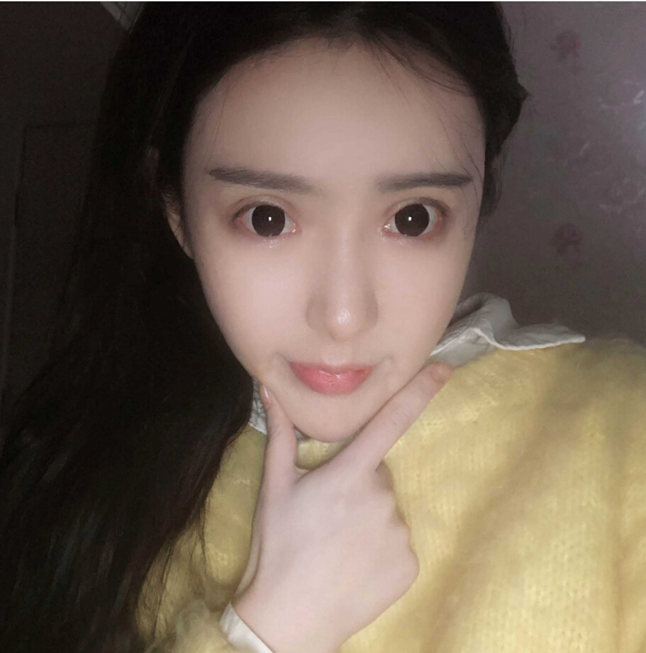 重庆柏漫医疗美容诊所高红艳医生做面部吸脂怎么样？面部吸脂案例分享