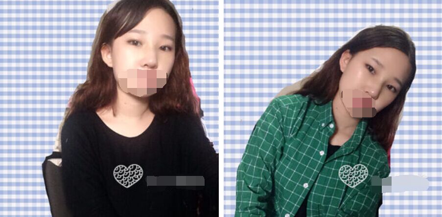珠海艾瑞医疗美容医院余昌盛医生做耳软骨隆鼻真实案例分享
