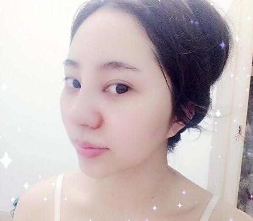 苏州明基医院医疗美容科做鼻综合整形怎么样？苏州明基鼻综合整形案例