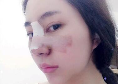 苏州明基医院医疗美容科做鼻综合整形怎么样？苏州明基鼻综合整形案例
