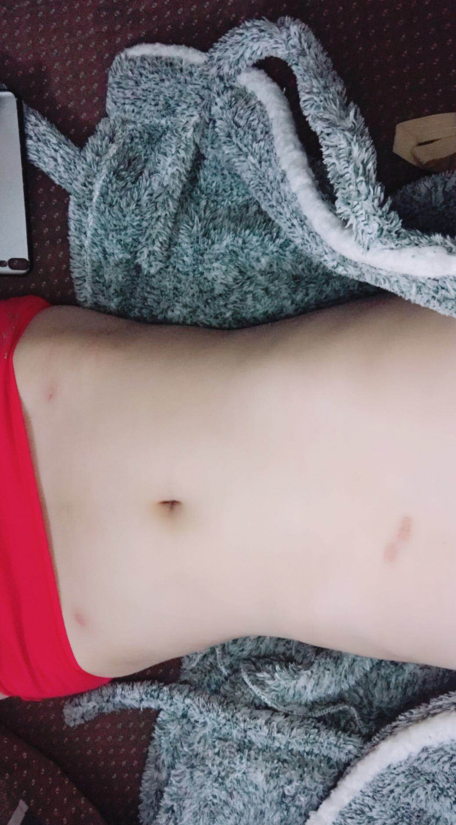 深圳晨曦整形医院吉米斯做腰腹吸脂怎么样？附吉米斯医生腰腹吸脂案例