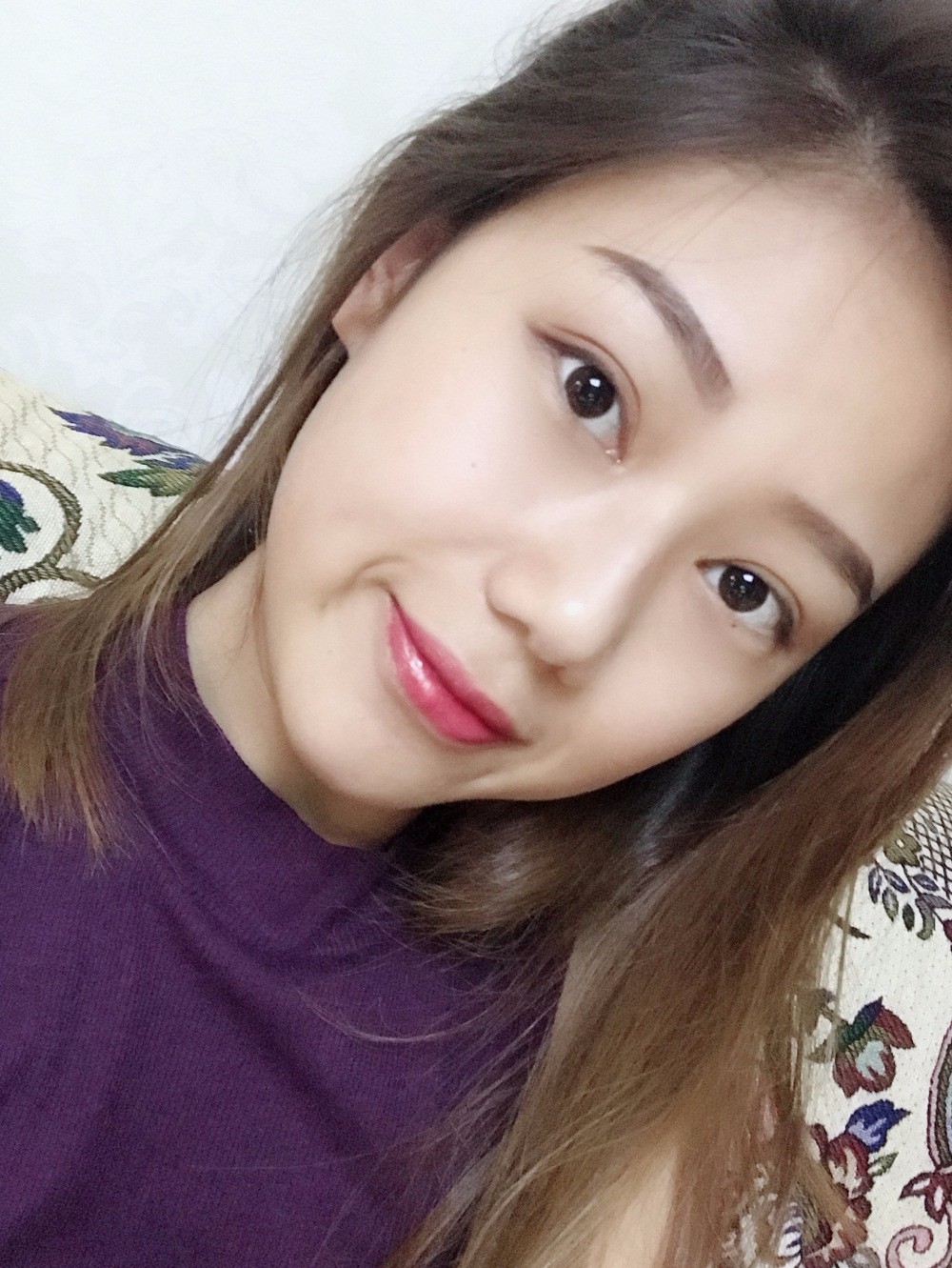 西安艺星埋线提升案例