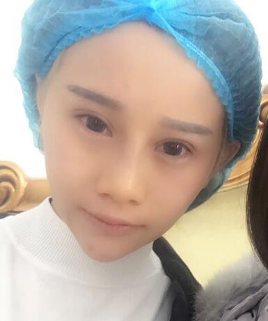 长春奥拉克美容医院金相勋医生做玻尿酸丰卧蚕怎么样？附案例