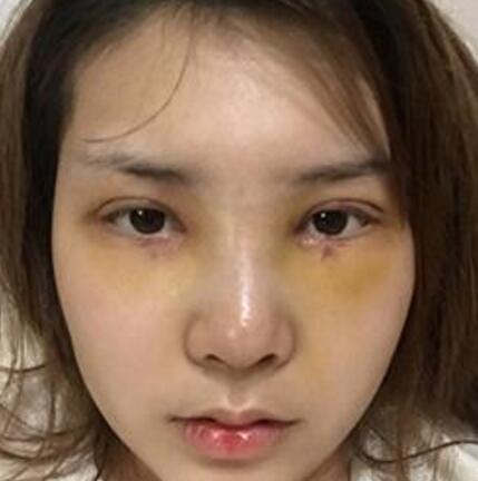 象山华美整形美容医院赵诚厚医生做切开双眼皮+开内眼角整形案例