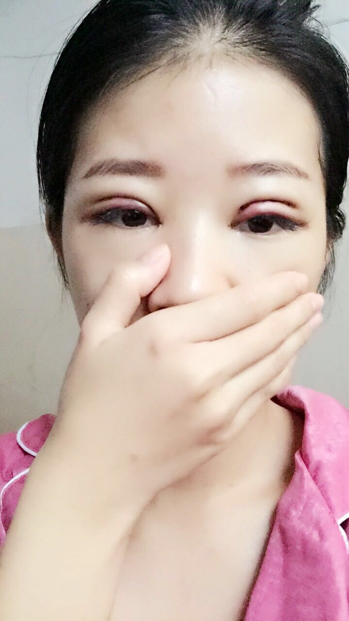 深圳晨曦医疗整形医生吉米斯做切开双眼皮怎么样？吉米斯切开双眼皮案例效果
