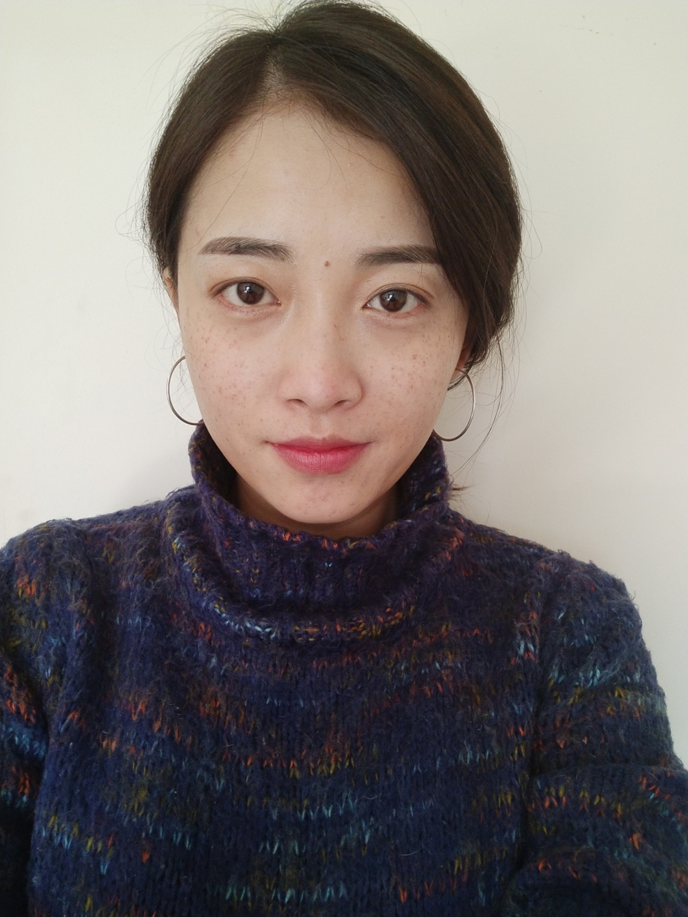 重庆当代整形李敏旭医生做皮秒激光祛斑效果怎么样？附皮秒激光祛斑案例