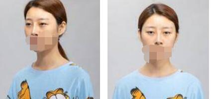 太原欧美莲整形医院丁晓峰医生做双眼皮怎么样？丁晓峰双眼皮手术案例分享