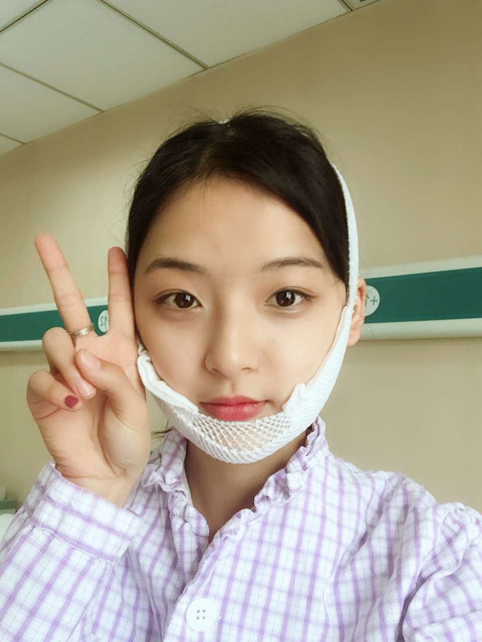 郑州名门整形医院董斌医生做下颌角整形怎么样？附下颌角整形案例