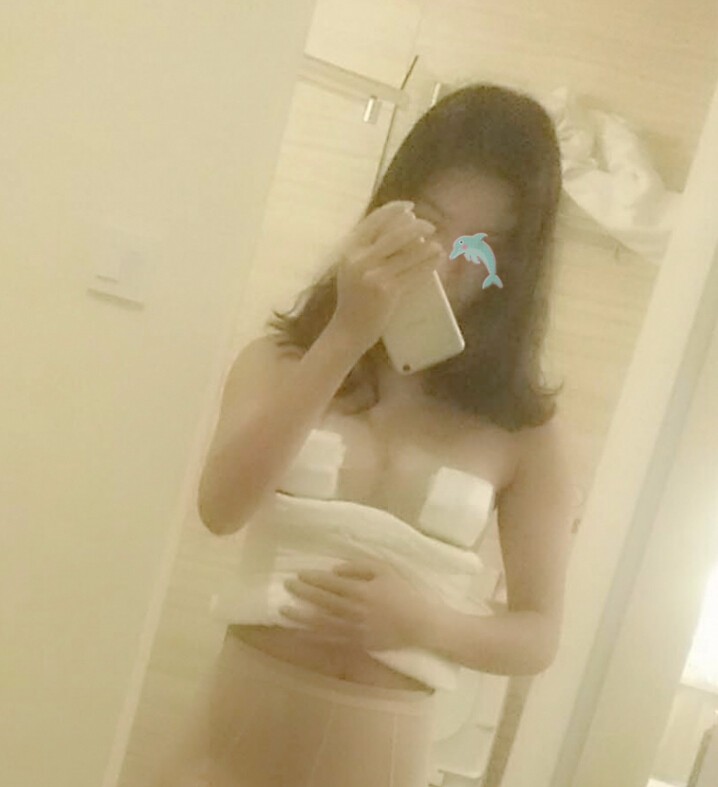 天津怡丽亚韩整形医院林海峰医生做自体脂肪隆胸真实案例效果对比图