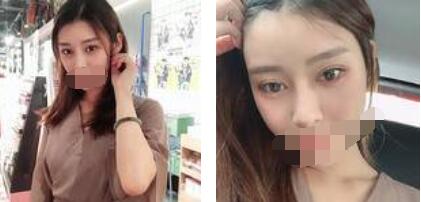 太原欧美莲整形医院丁晓峰医生做双眼皮怎么样？丁晓峰双眼皮手术案例分享