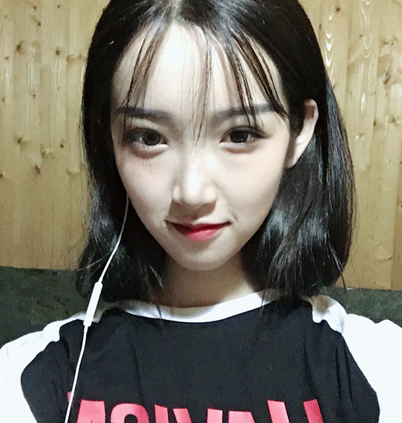 重庆威妮医疗整形医生伊莉做切开双眼皮+开眼角真人案例效果对比图