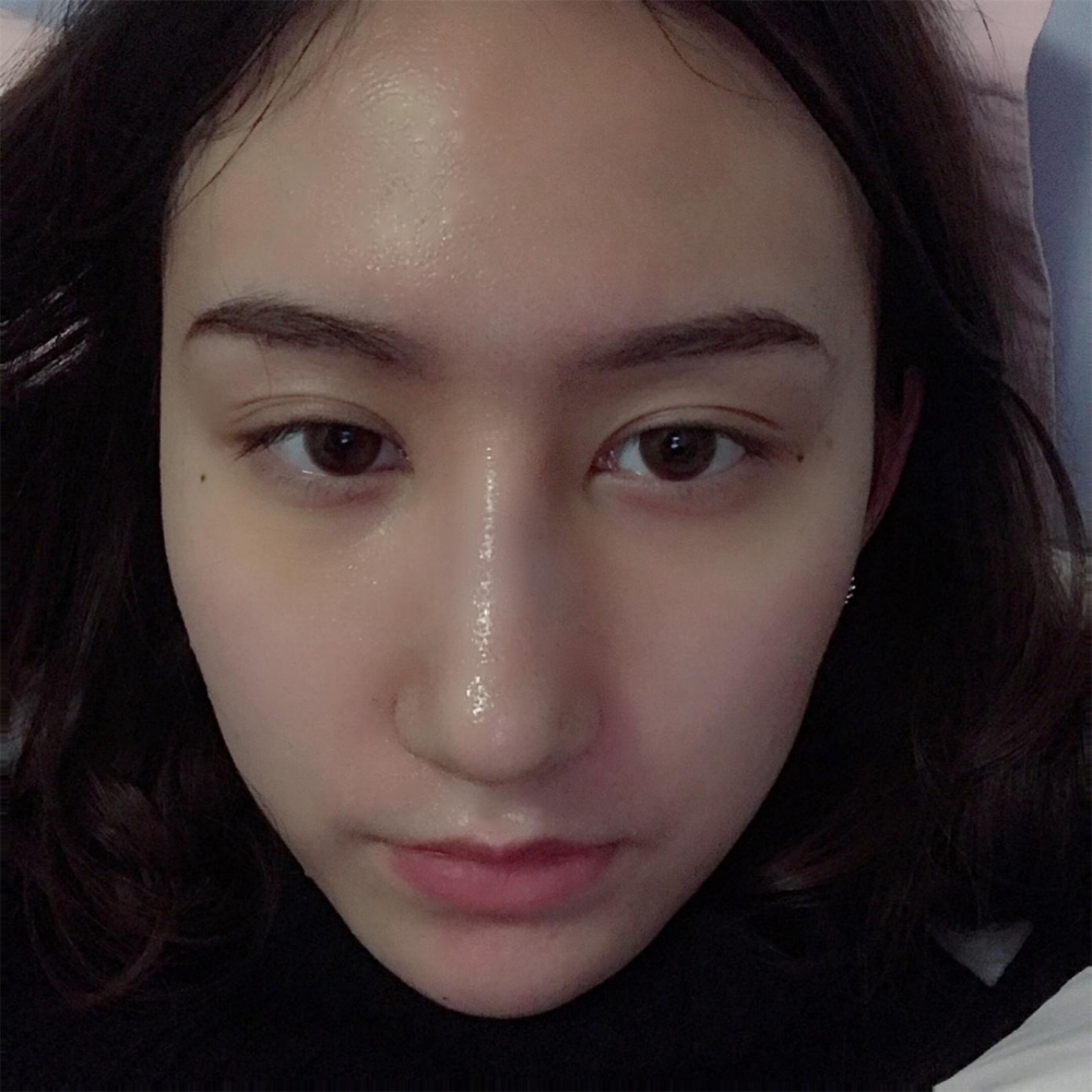 烟台洛神医学美容医院张瑞允医生做硅胶隆鼻怎么样？附硅胶隆鼻案例