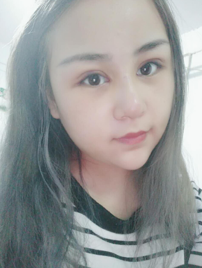 郑州美丽时光整形医生马战胜做双眼皮+隆胸案例效果对比图