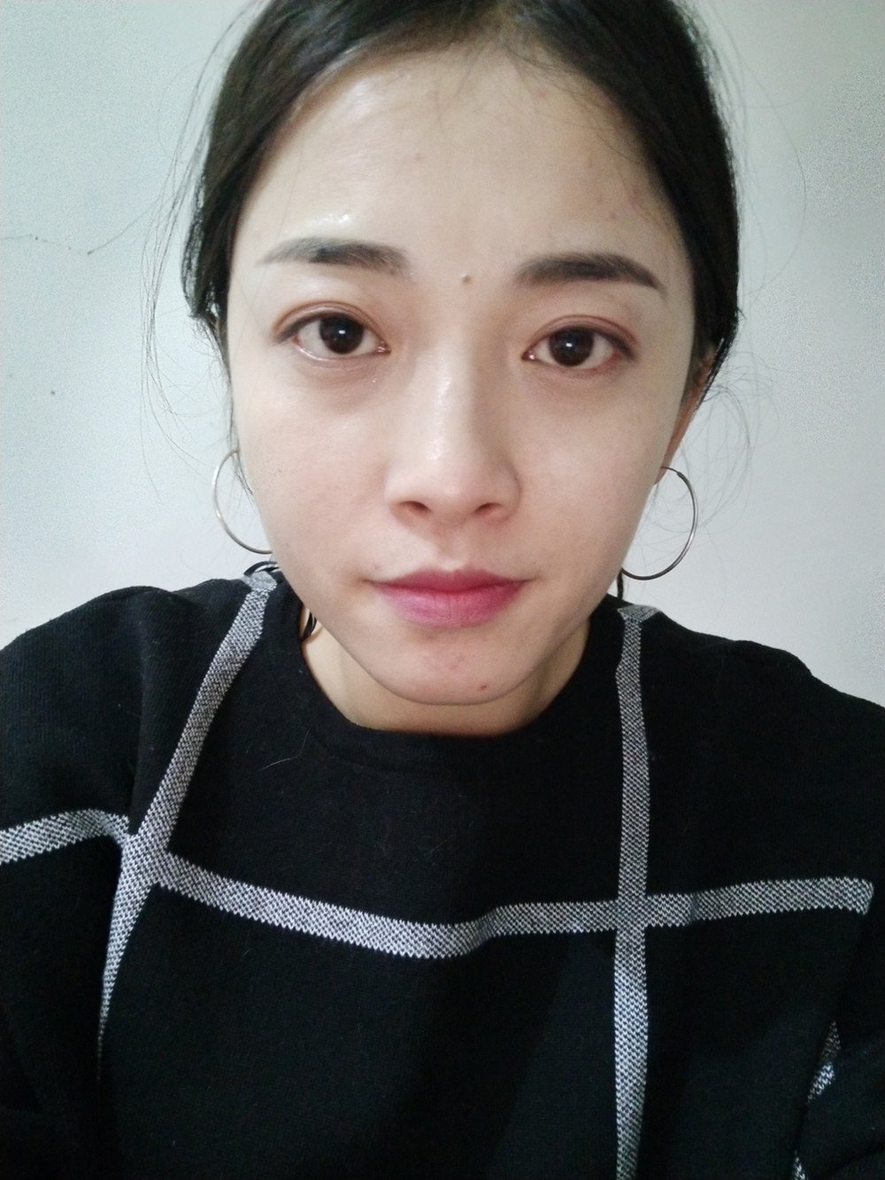 重庆当代整形李敏旭医生做皮秒激光祛斑效果怎么样？附皮秒激光祛斑案例