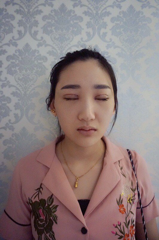 武汉中翰整形外科医院沈磊医生做切开双眼皮怎么样？附沈磊切开双眼皮案例