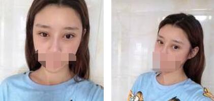 太原欧美莲整形医院丁晓峰医生做双眼皮怎么样？丁晓峰双眼皮手术案例分享
