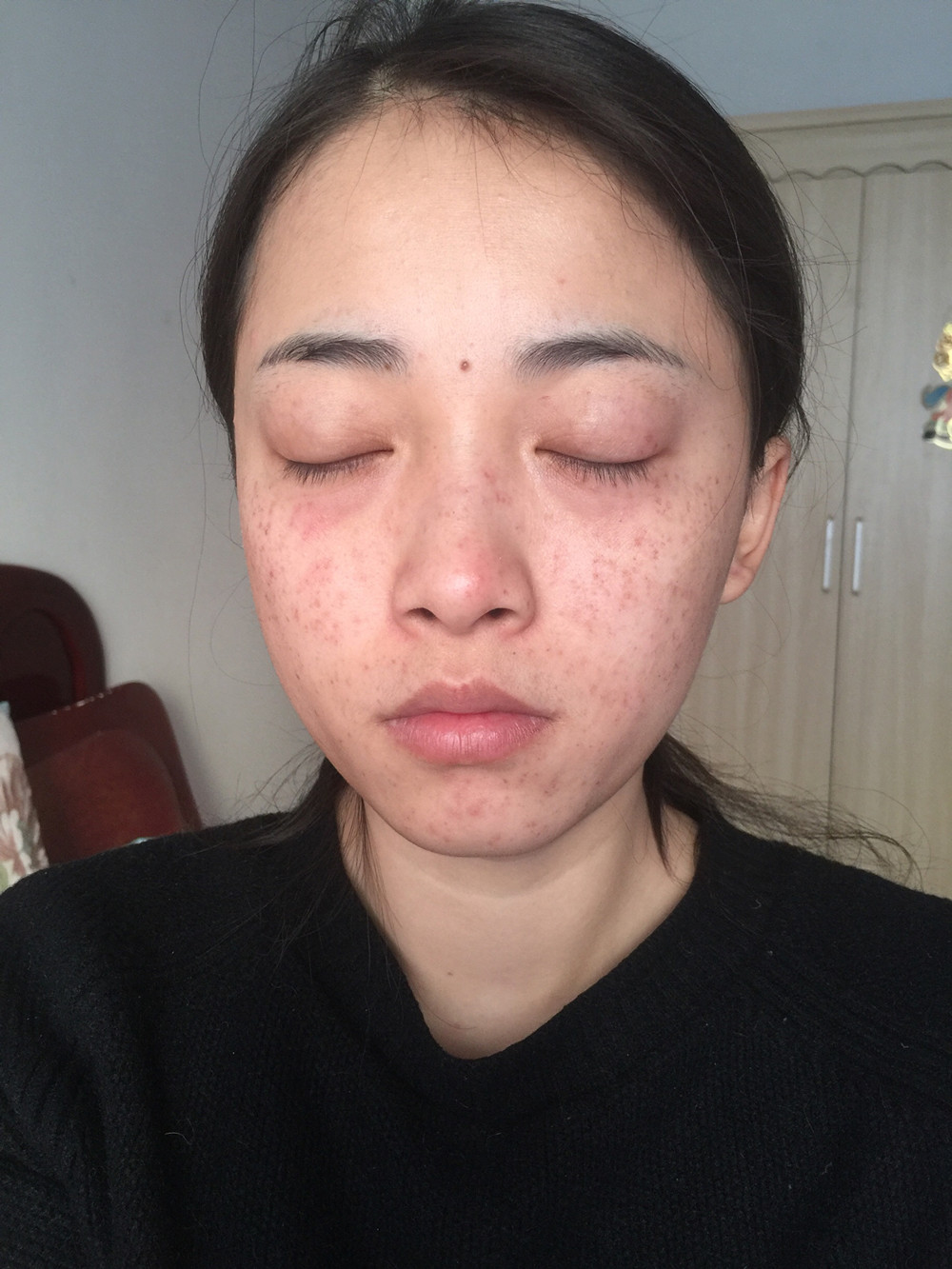 重庆当代整形李敏旭医生做皮秒激光祛斑效果怎么样？附皮秒激光祛斑案例