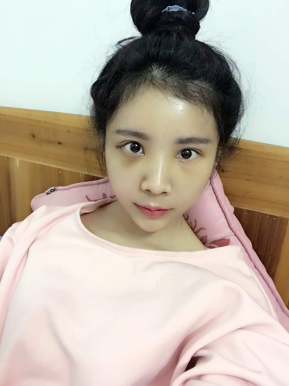 西安高一生医疗美容医院网购恒医生做自体脂肪全脸填充案例效果对比图
