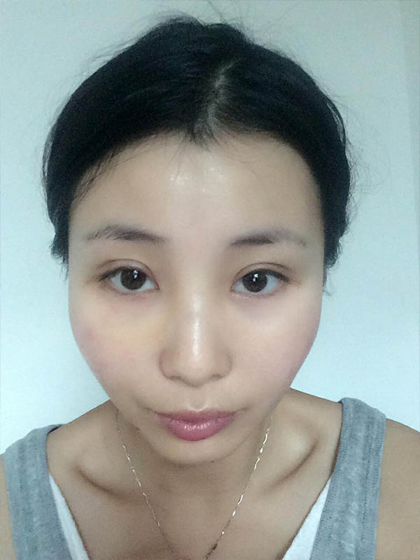 桂林新华医疗美容医生李新华做双眼皮手术怎么样？李新华双眼皮手术案例