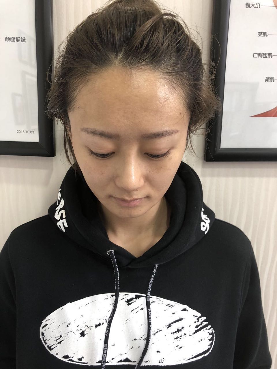 杭州迪美整形常德成医生做鼻综合整形技术怎么样？附鼻综合整形案例