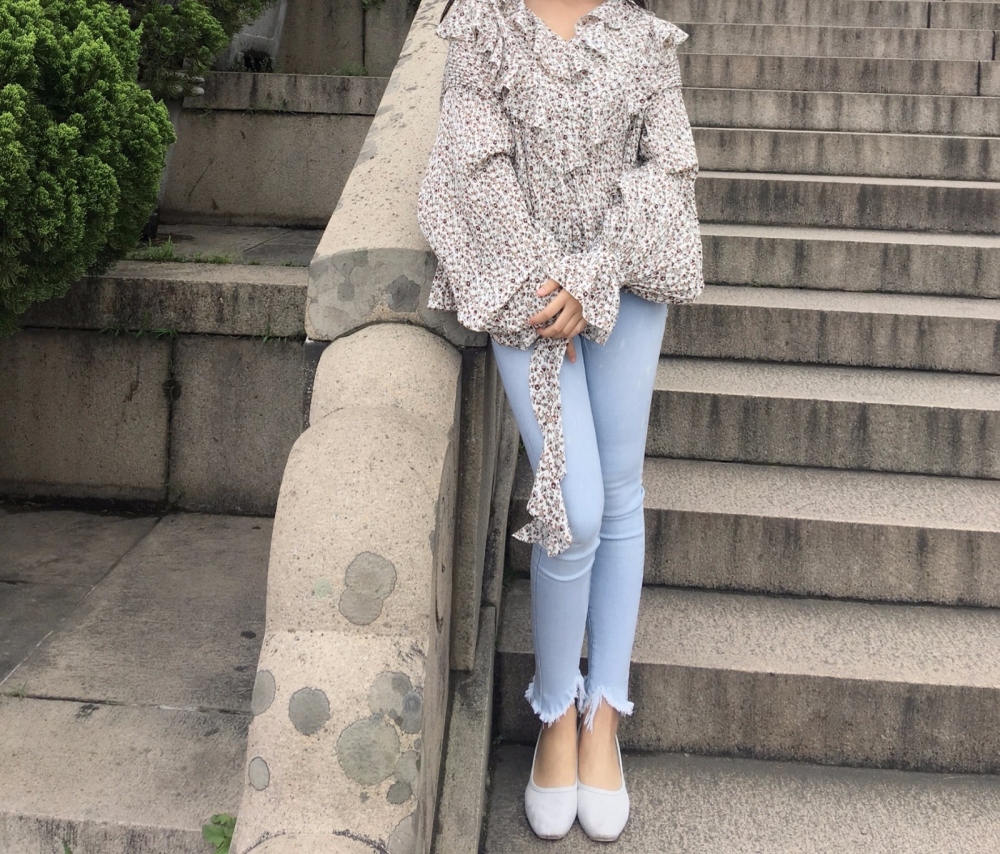 晋城凤凰整形美容医院宋发兴医生做大腿吸脂怎么样？附大腿吸脂案例