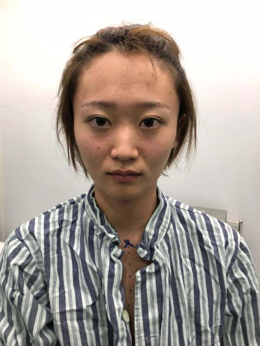 杭州迪美整形常德成医生做鼻综合整形技术怎么样？附鼻综合整形案例