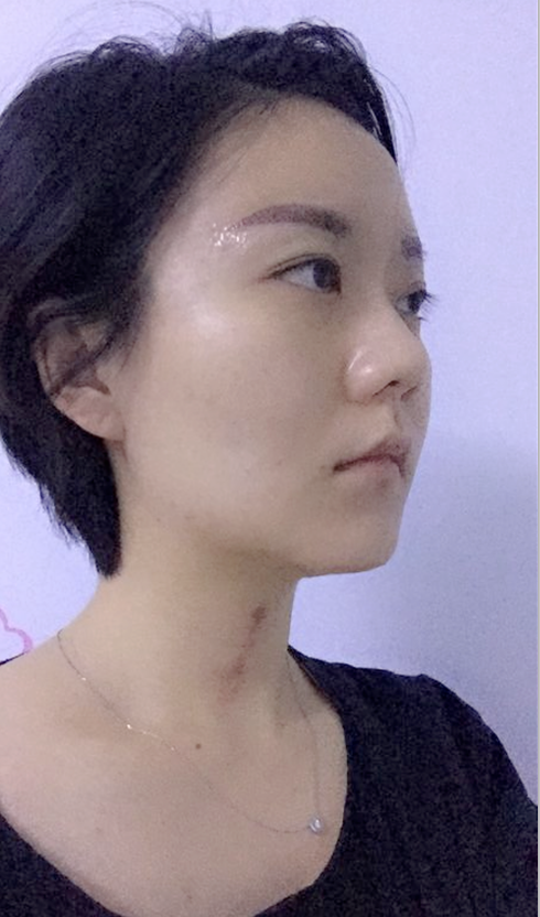 沈阳友谊整形美容医院金顕哲医生做自体脂肪填充脸部+V-LINE瓜子脸手术案例效果图