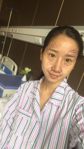 湛江澳泰整形医院彭鑫医生做自体脂肪丰苹果肌+太阳穴案例效果对比图