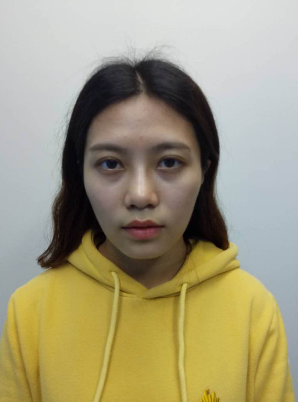 重庆美圣美邦整形医院刘力维医生做自体脂肪全脸填充案例效果对比图