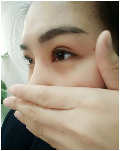 营口臻美医疗整形医生闫迎军做双眼皮效果怎么样？附双眼皮案例对比图