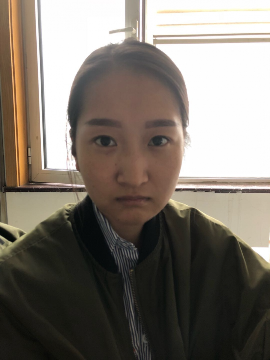 广州广大整形美容医院任生医生做玻尿酸丰面颊+注射瘦脸案例效果对比图